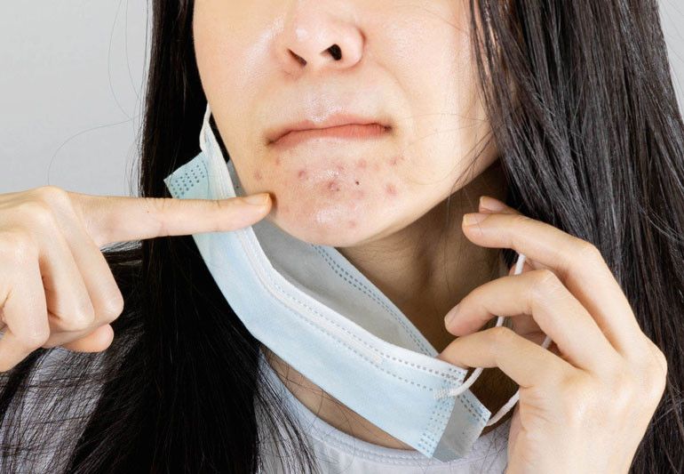 Cómo evitar el acné y la dermatitis que puede causar la mascarilla