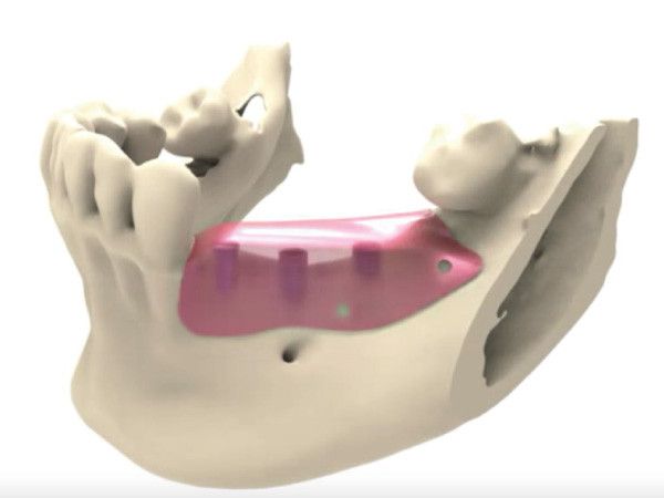 Thumbnail regeneracion osea parcial clinica dental jorge mato verin salamanca la alberca