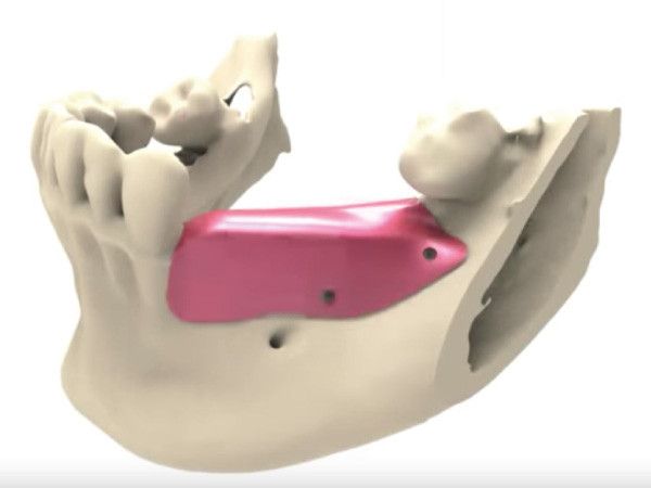 Regeneracion osea barrera oclusiva clinica dental jorge mato verin salamanca la alberca (1)